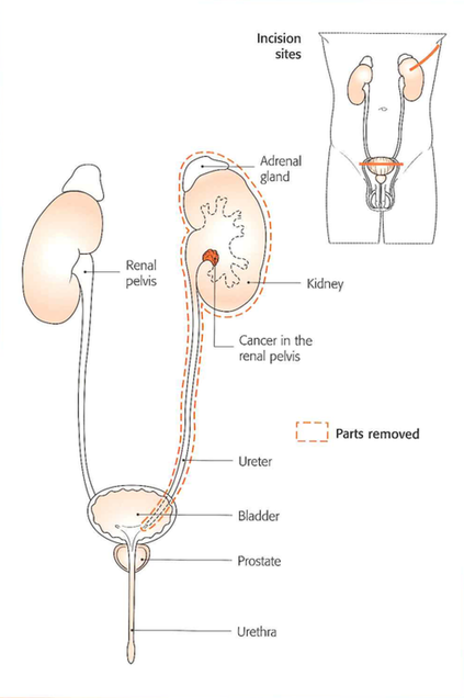 Nieres un urīnvada izņemšana